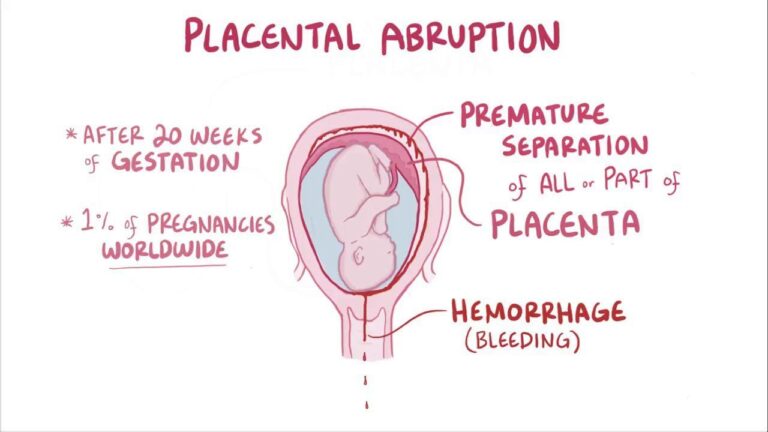 Placental Abruption Symptoms
