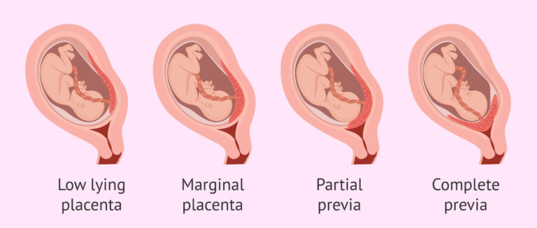 Placenta Previa Types