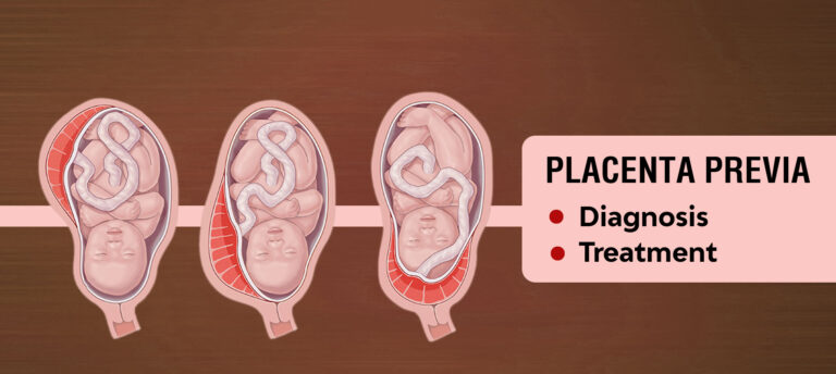 Placenta Previa Treatment