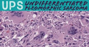 What is Undifferentiated Pleomorphic Sarcoma?