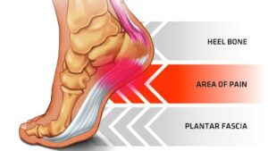 Plantar Fasciitis