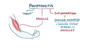 What is Polymyositis?