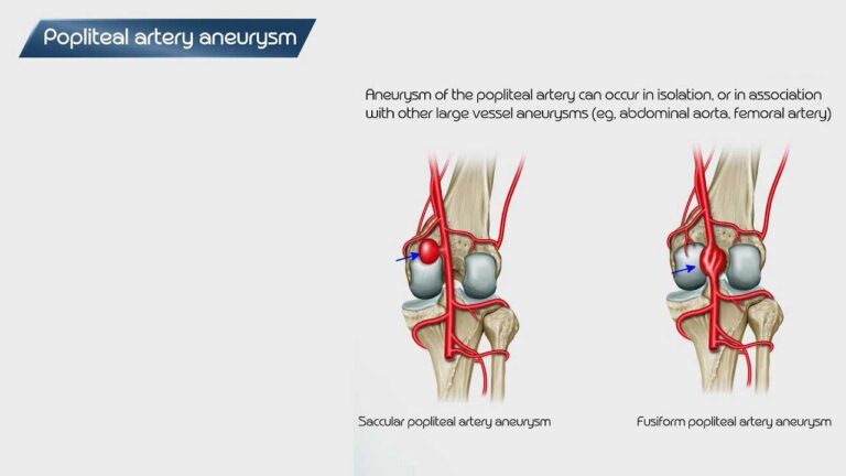 Popliteal Artery Aneurysm Treatment