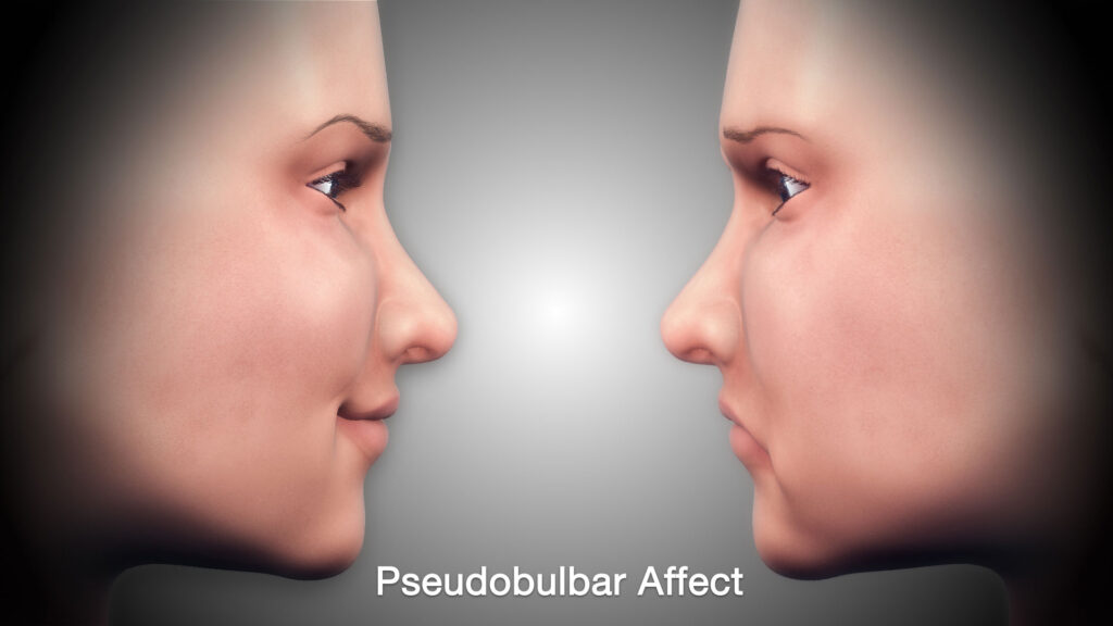 Pseudobulbar Affect