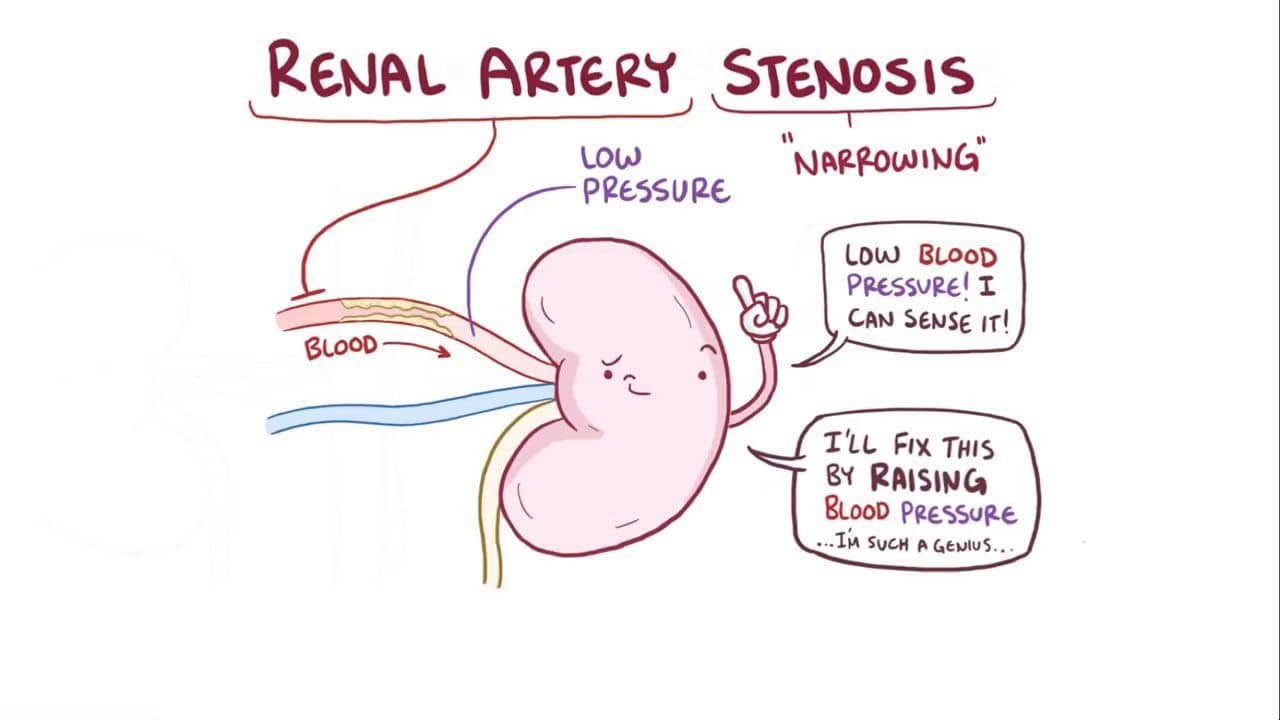 causes of renal artery stenosis