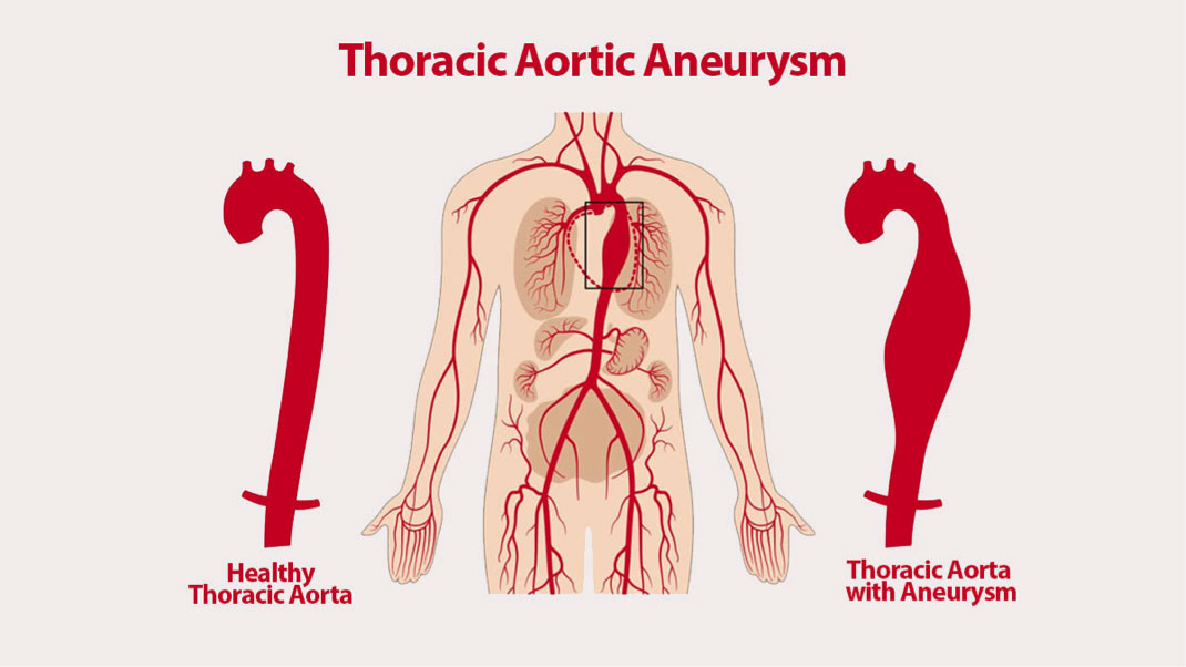 Aortic Aneurysm