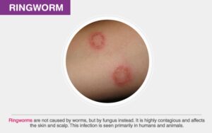 What is Ringworm?