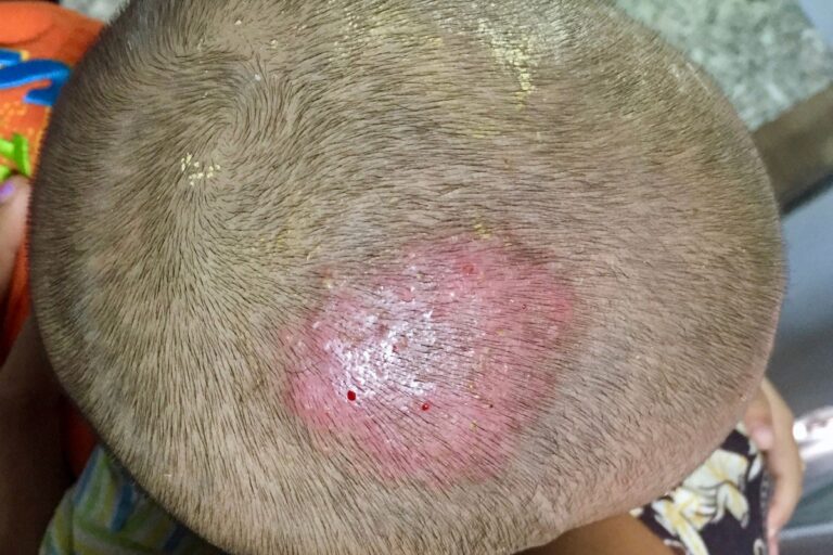 What is Ringworm (Scalp)?