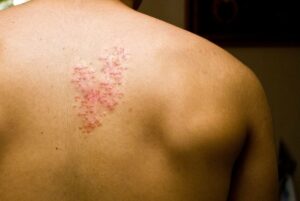 Shingles: Symptoms, Treatment, and Causes