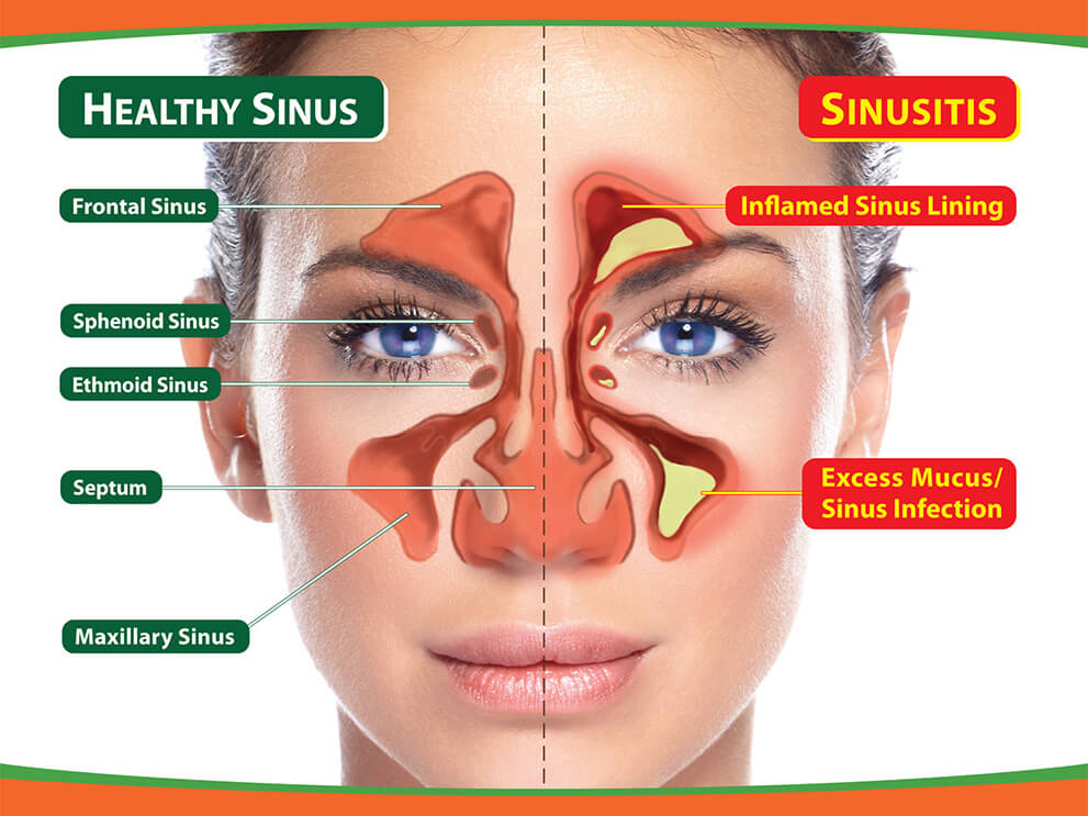 Difference between a Healthy Sinus and a person having Sinusitis