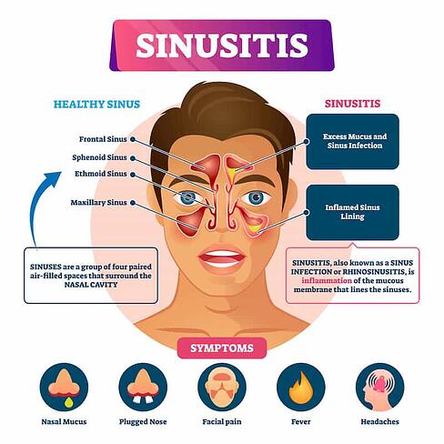 sinusitis symptoms