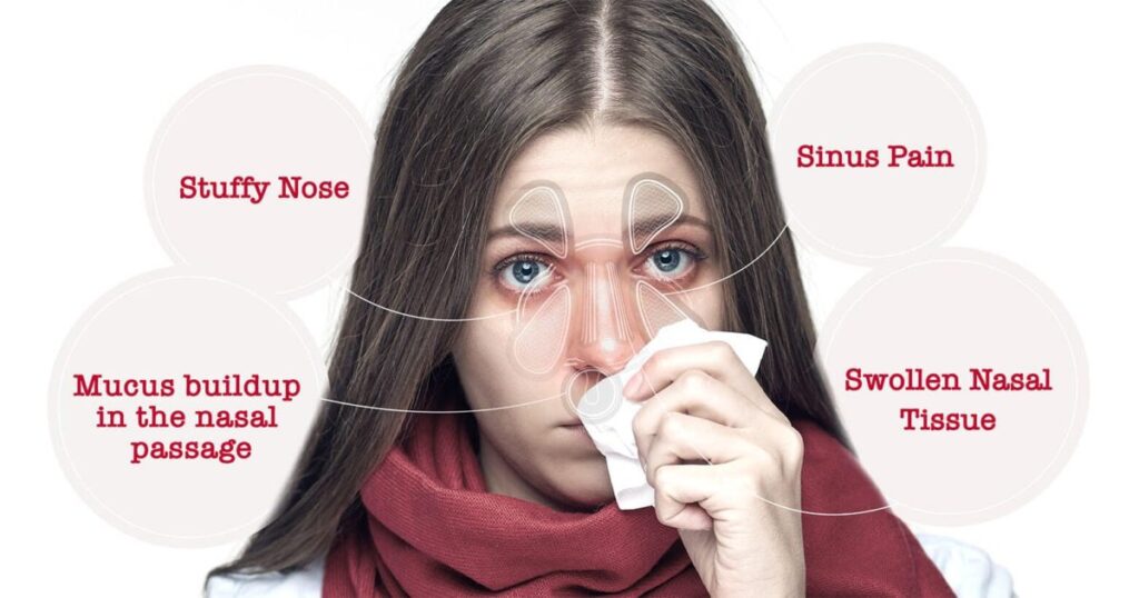 sinusitis treatments