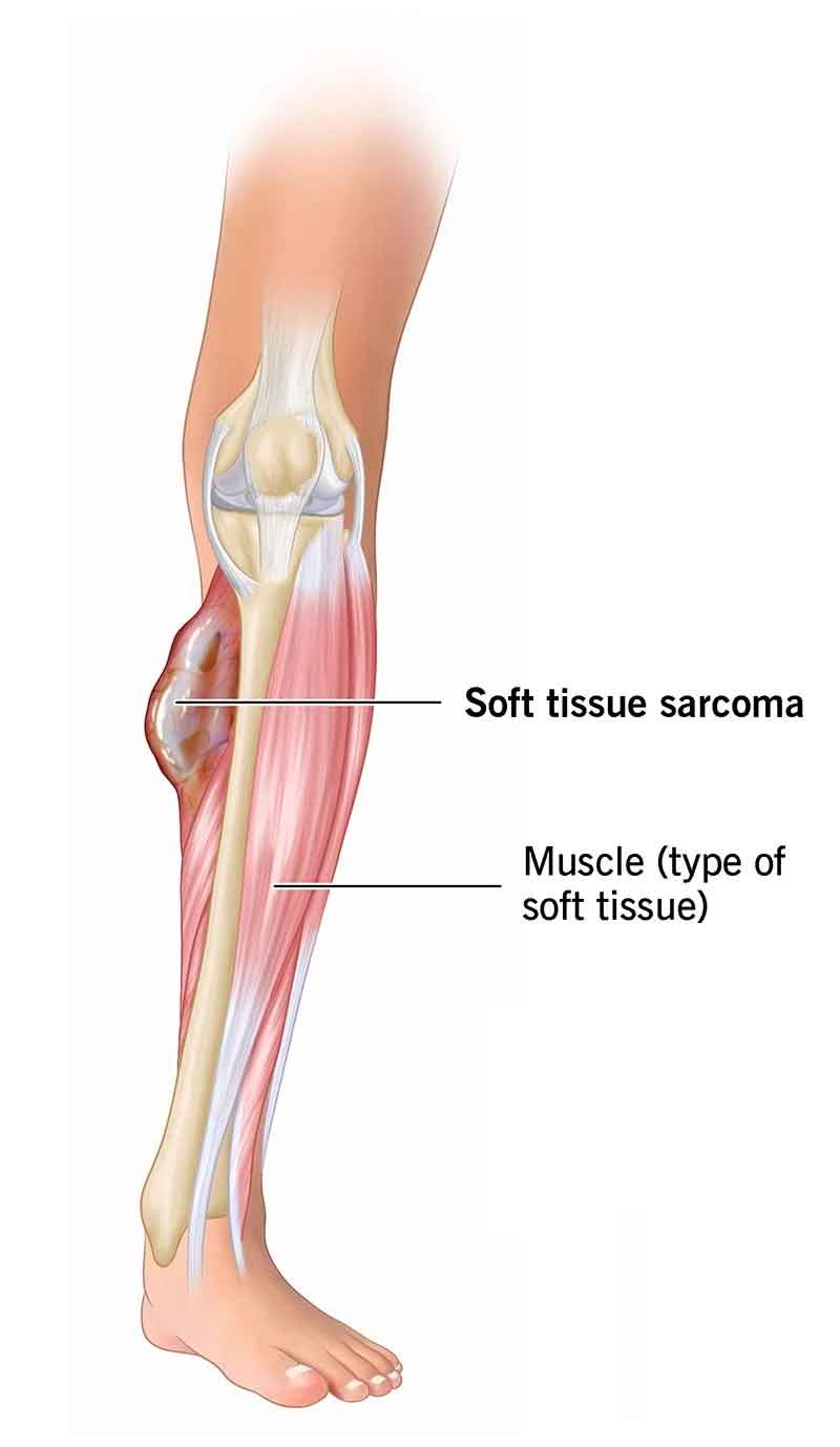 What is Soft Tissue Sarcoma?