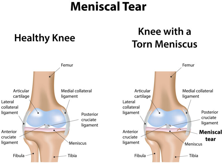Knee with a Meniscus Tear