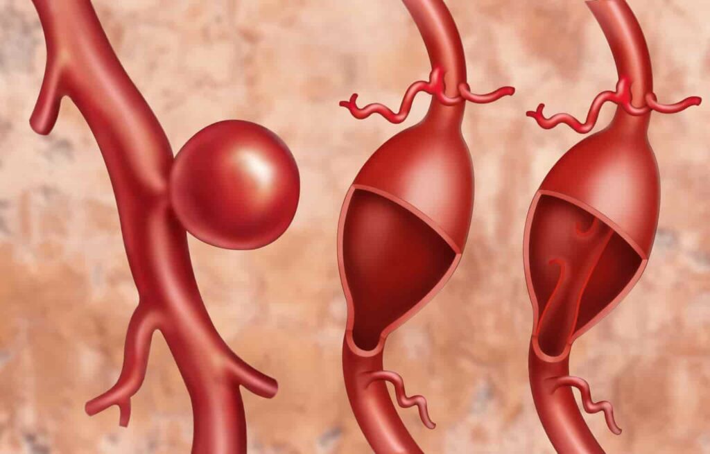 Thoracic Aortic Aneurysm