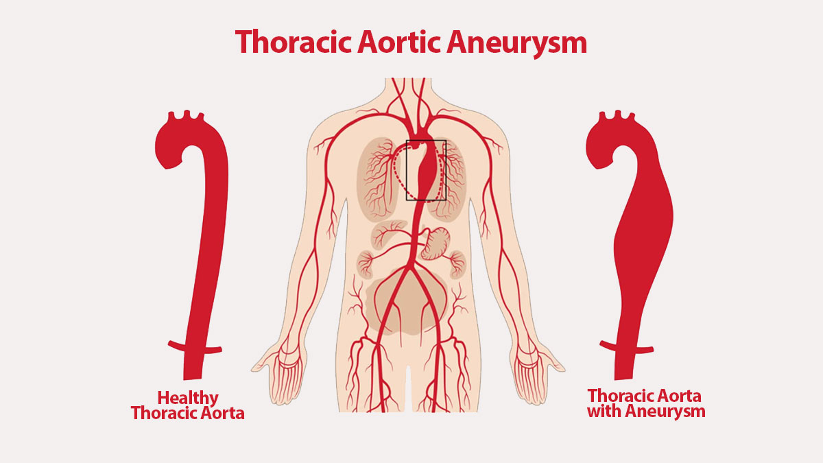 thoracic aortic aneurysm icd 10