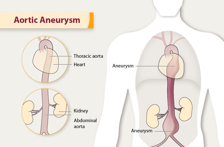 thoracic aortic aneurysm treatment