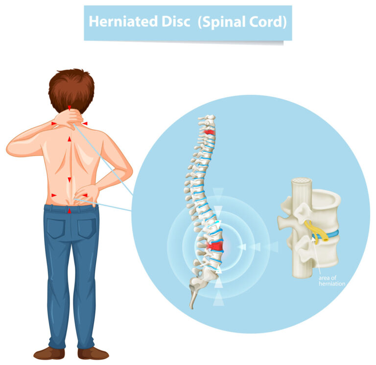 Herniated or Bulging Disc