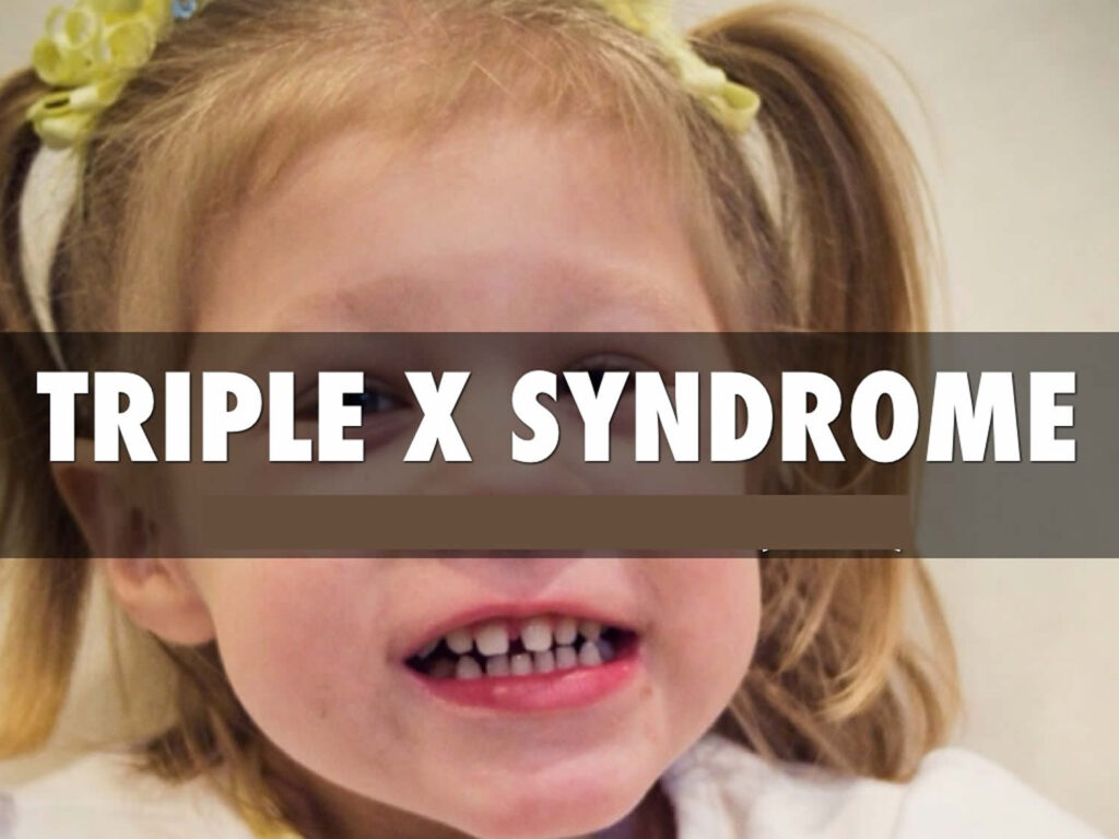 triple x syndrome