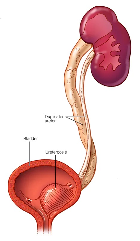 Ureteral Obstruction Surgery