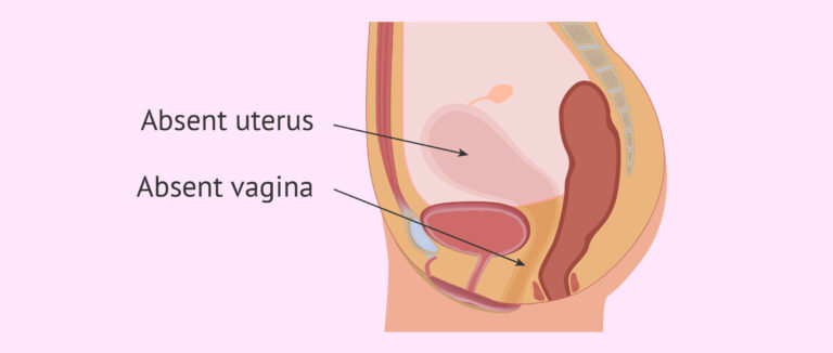 What is Vaginal Agenesis?