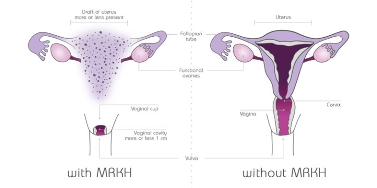 Vaginal Agenesis