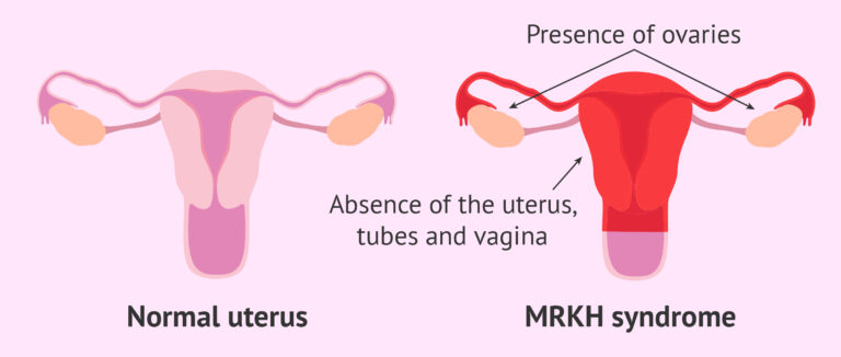 Mayer-Rokitansky-Kuster-Hauser (MRKH) Syndrome