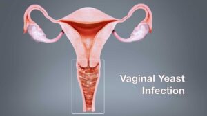 What is a Vaginal Yeast Infection?
