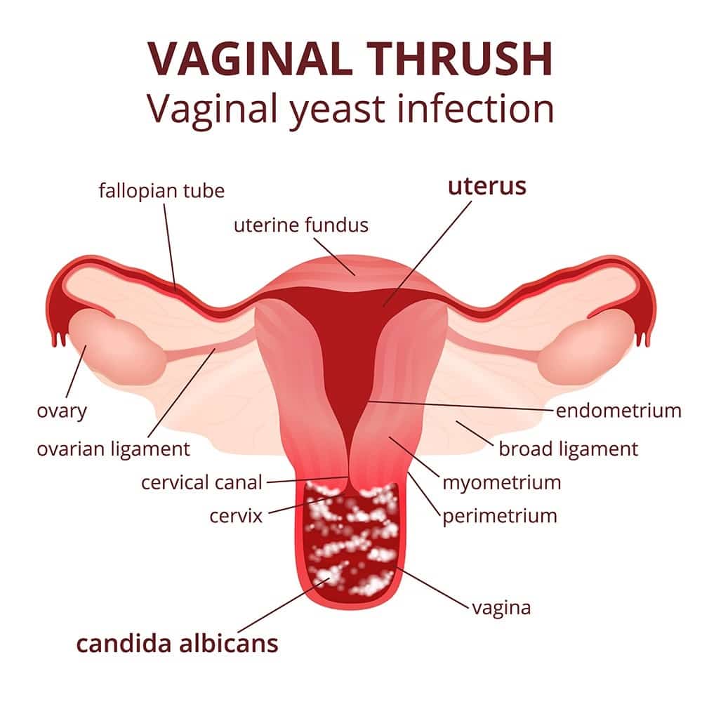 Vaginal Yeast Infection Complication