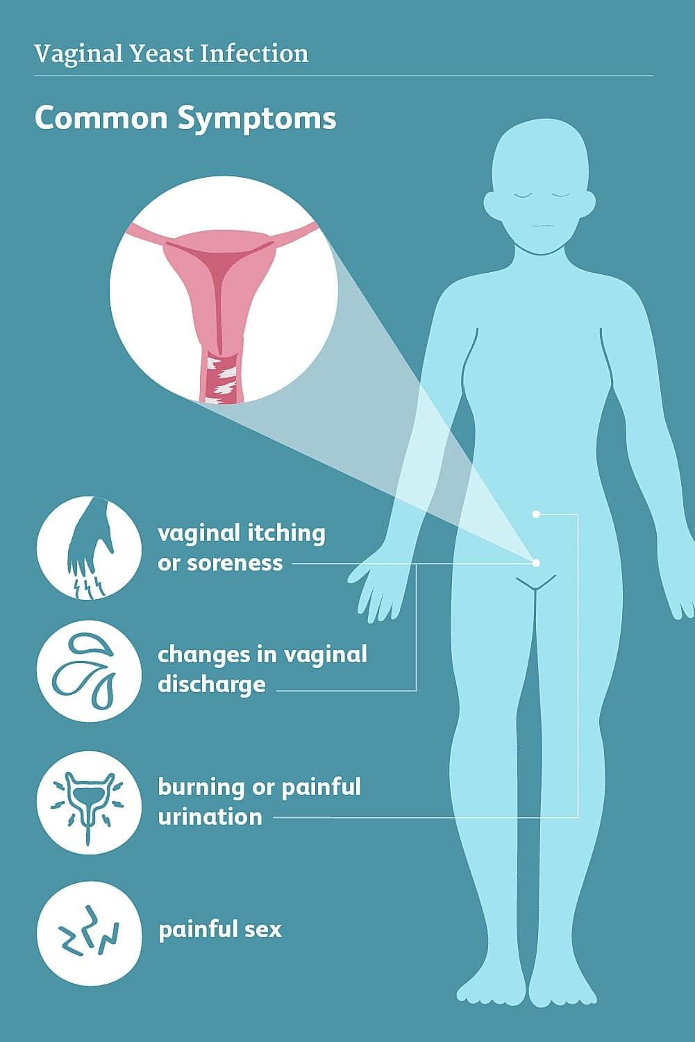 vaginal yeast infection symptoms