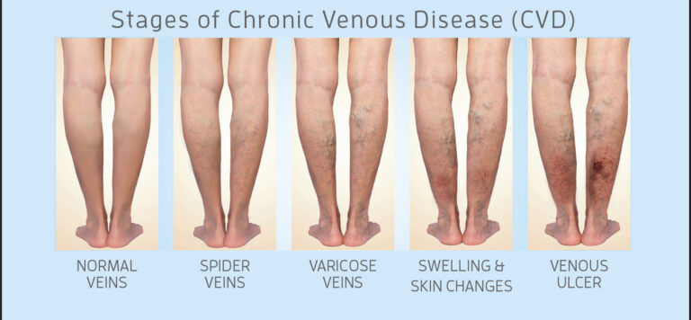 varicose vein and feet pain
