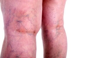 varicose veins