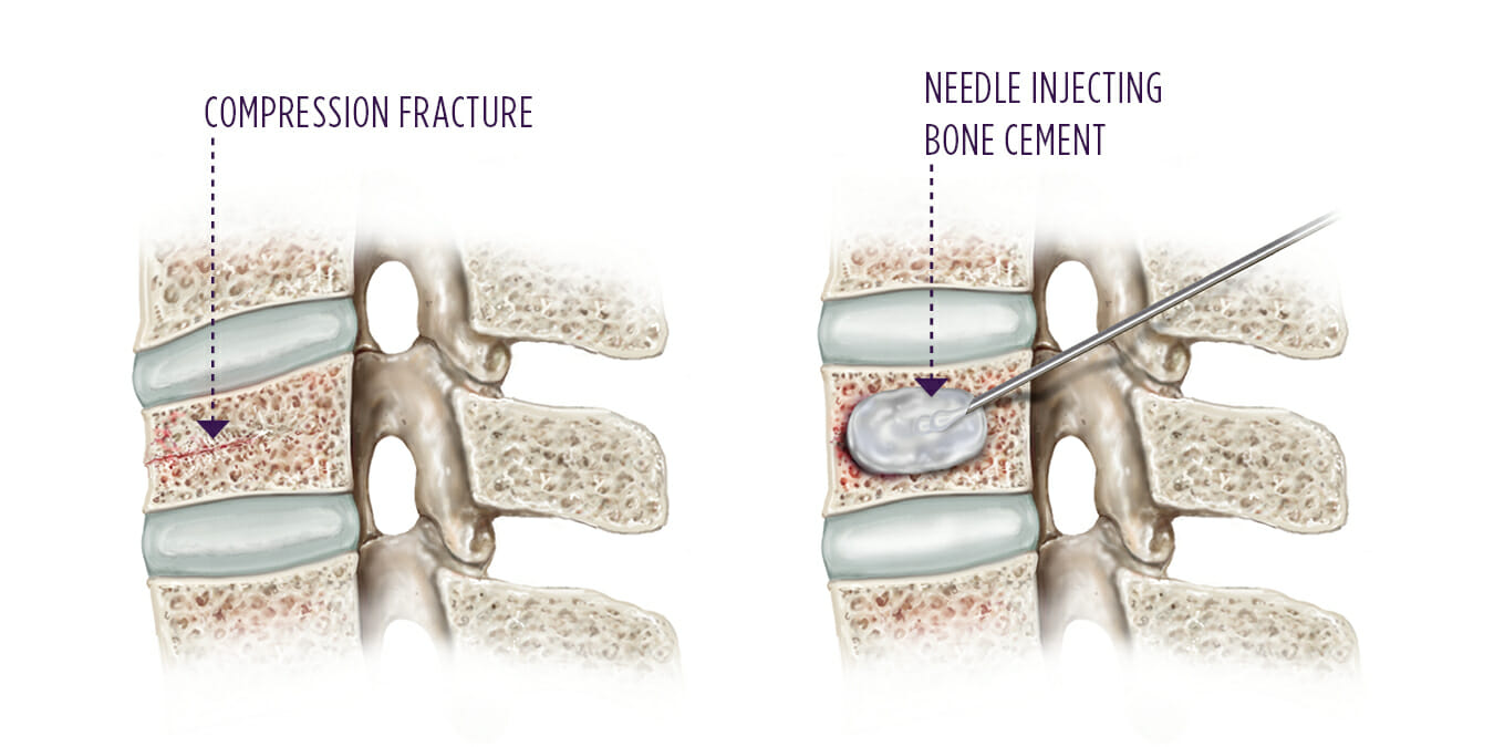 RISK AND COMPLICATIONS OF VERTEBROPLASTY