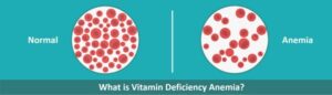 What is Vitamin Deficiency Anemia?