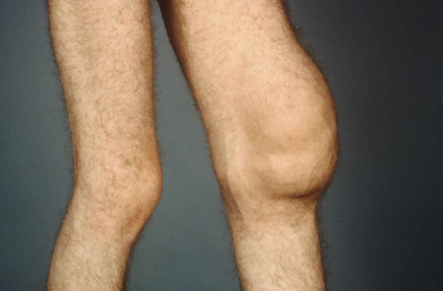 Water on the Knee (Joint Effusion)
