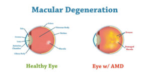 What is Wet Macular Degeneration?