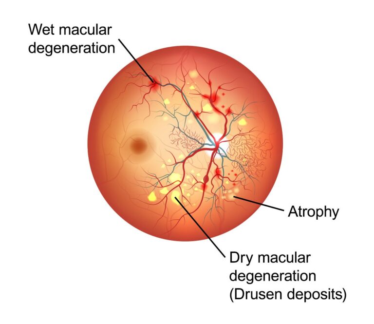 Wet Macular Degeneration