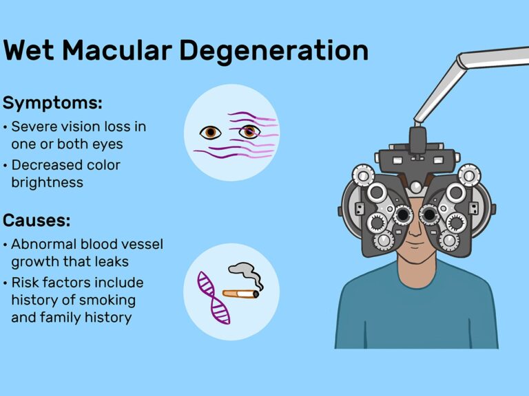 Wet Macular Degeneration Symptoms & Causes