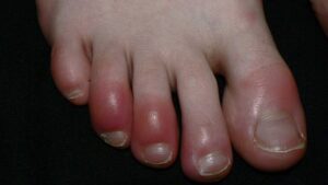 What is Chilblains?
