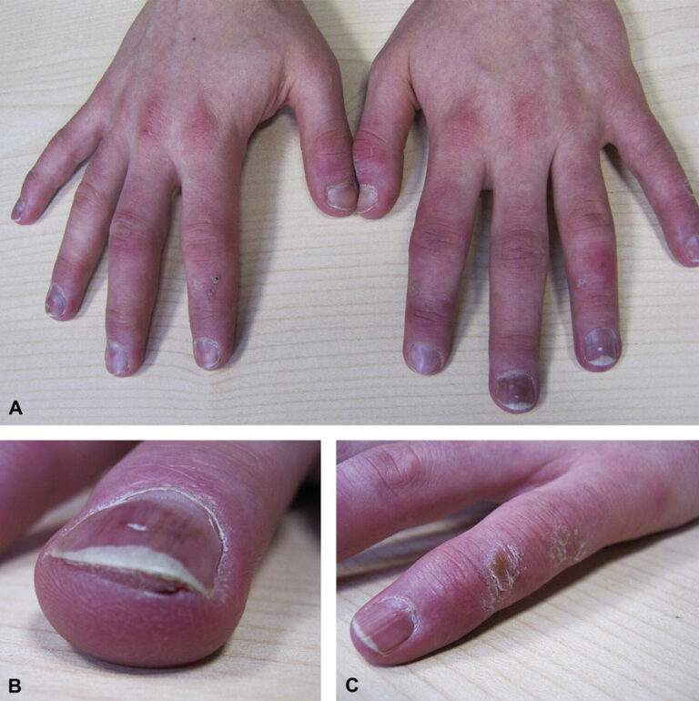 Chilblains Treatment
