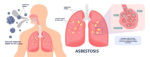 What is Asbestosis?
