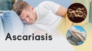 What is Ascariasis?