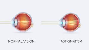 What is Astigmatism?