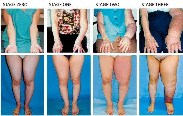 lymphedema stages