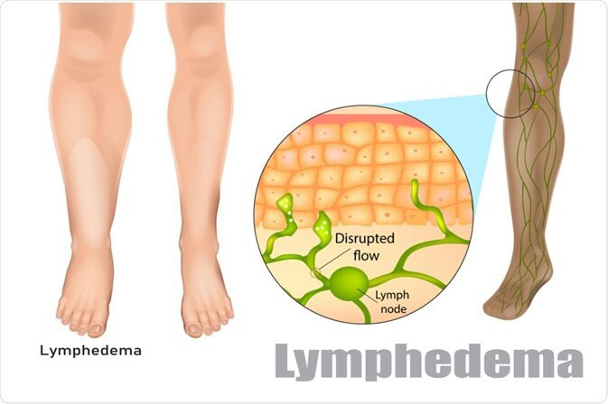 lymphedema causes