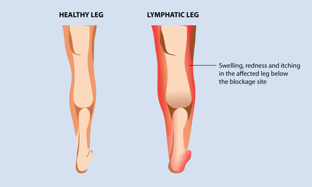 lymphedema treatments