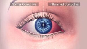 What is Conjunctivitis?