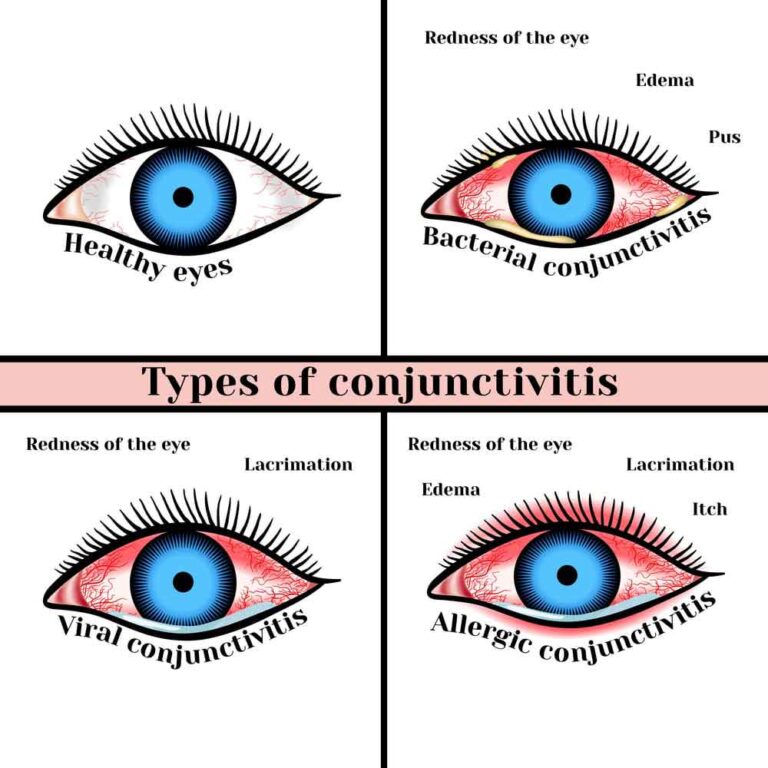 Types of Conjunctivitis