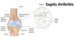 What is Septic Arthritis?