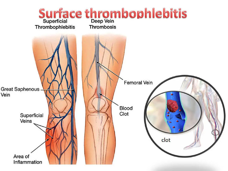 Superficial Thrombophlebitis